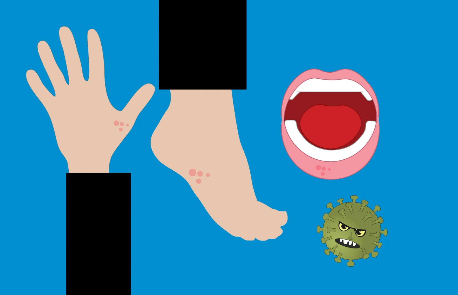 Zona (Herpes Zoster)