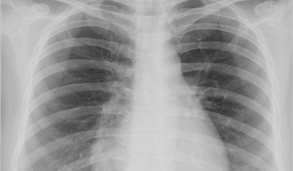 Asbest Hastalığı Nedir?