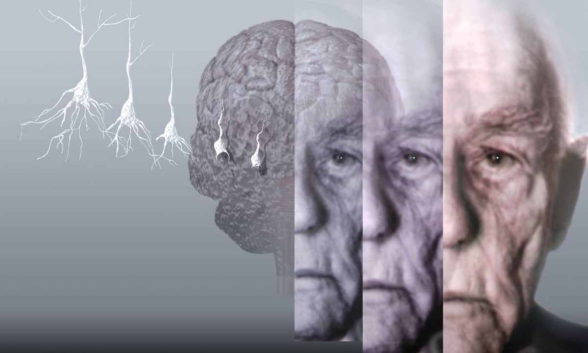 Alzheimer Hastalığı