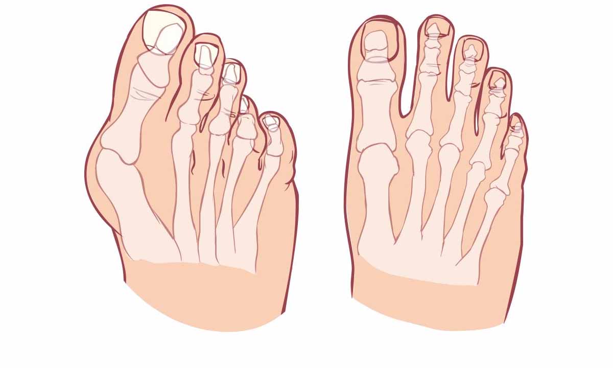 Halluks Valgus
