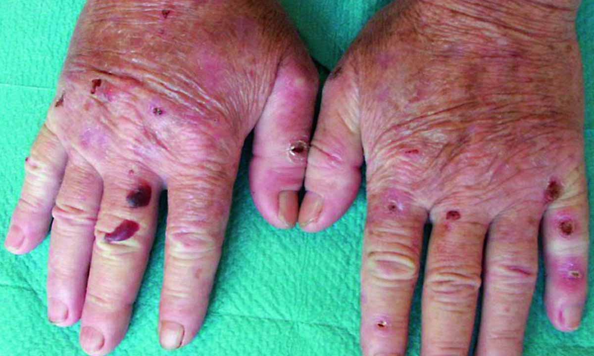 Porfiria (Porphyria)