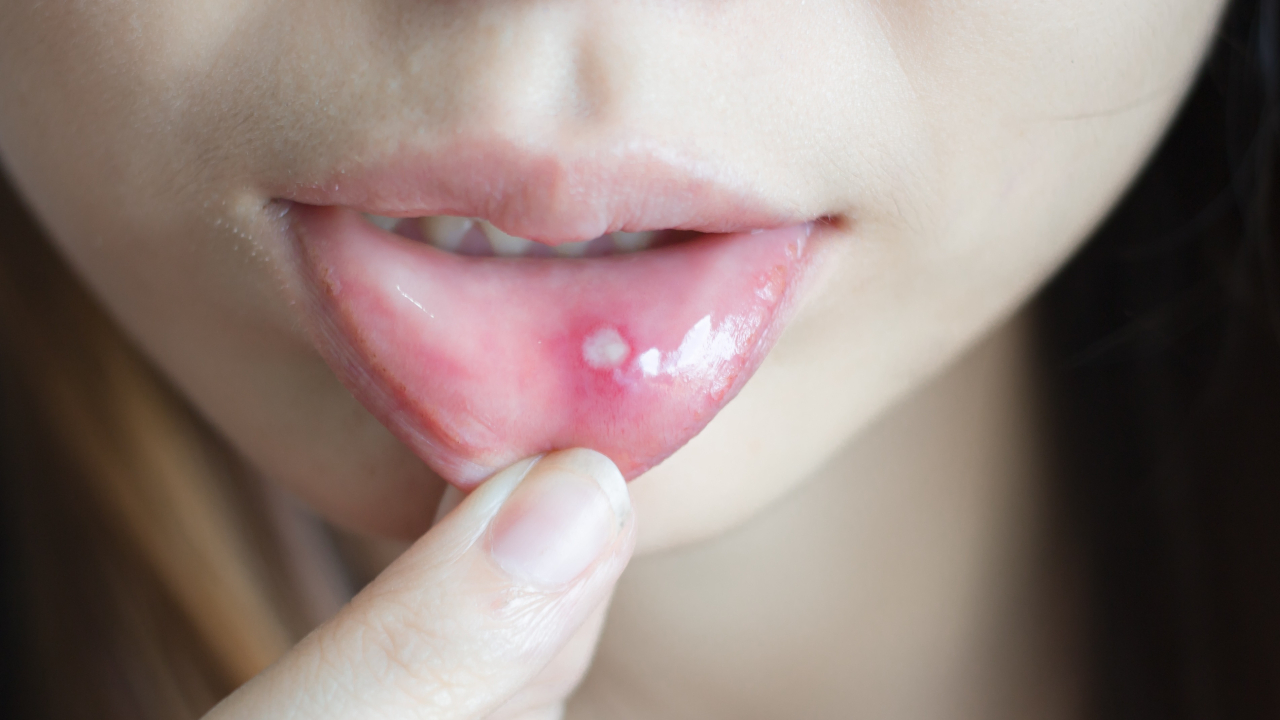 Behçet Hastalığı Nedir?