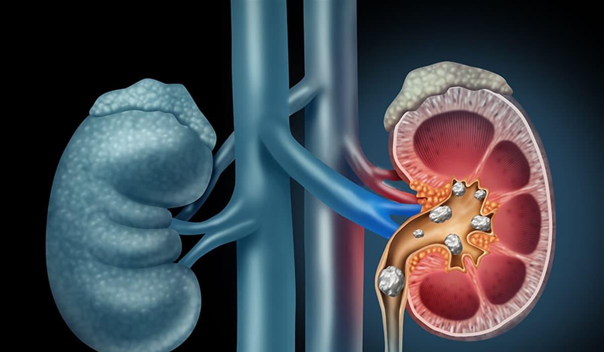 Böbrek Taşı Nasıl Oluşur?