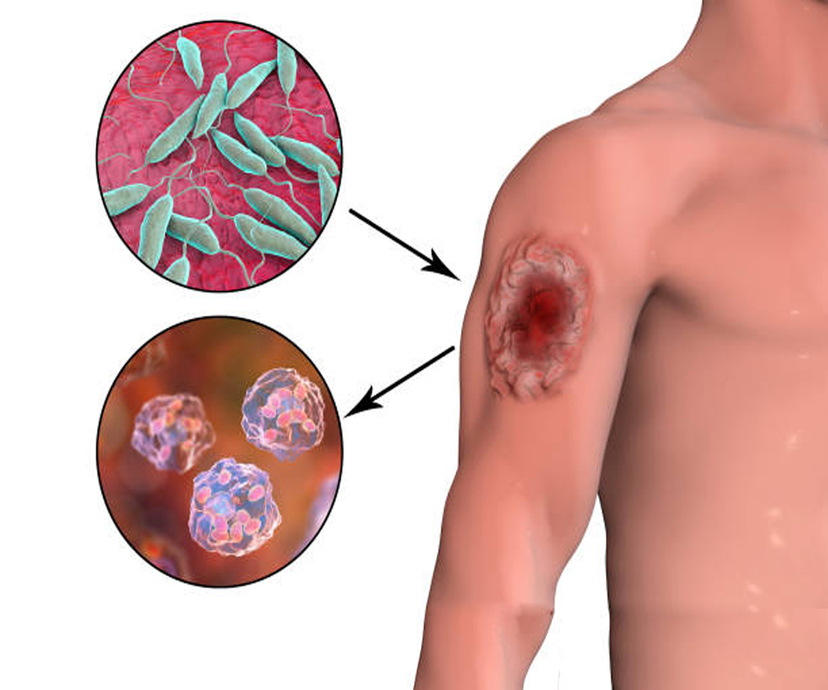 Layşmanyaz Hastalığı Nedir?
