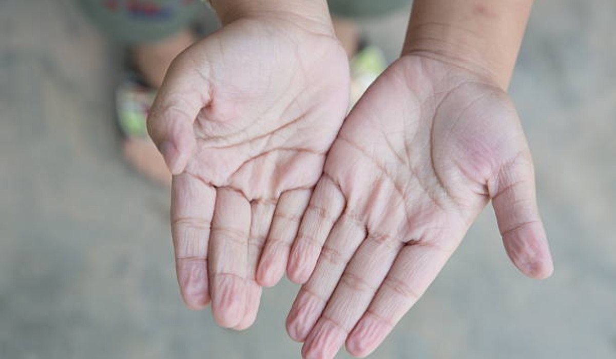 Skleroderma Hastalığı Nedir?