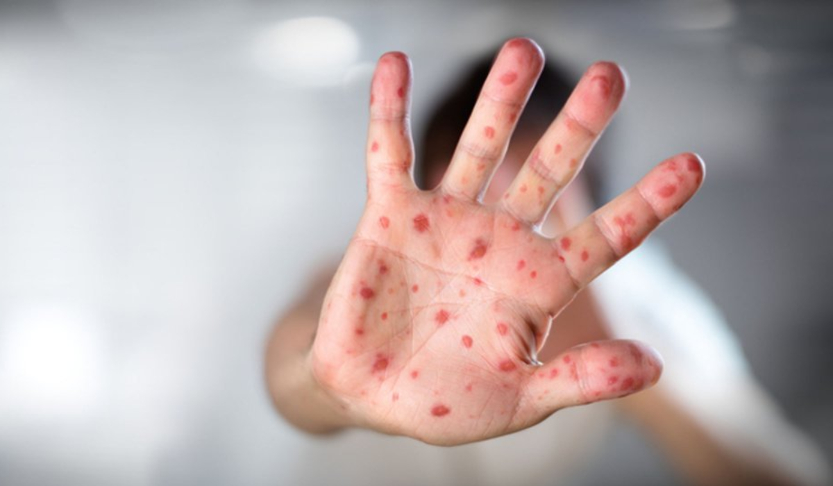 Zona Hastalığı Bulaşıcımıdır?