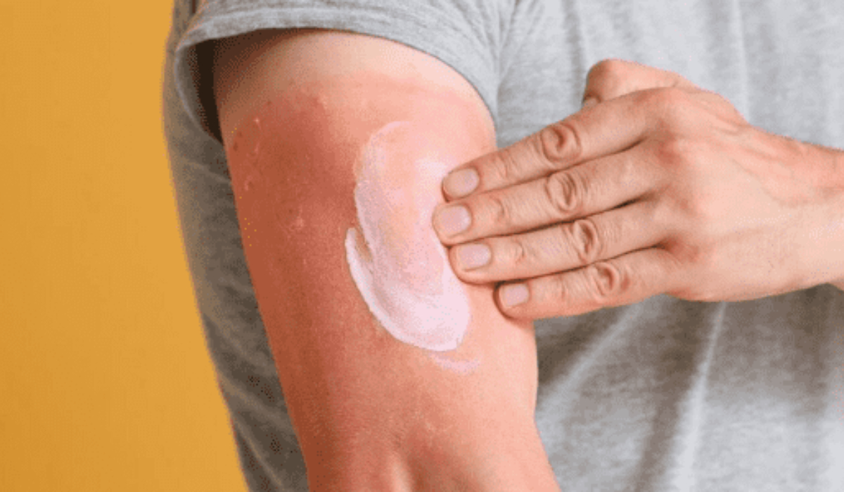 Güneş Yanığına Karşı Doğal Yöntemler