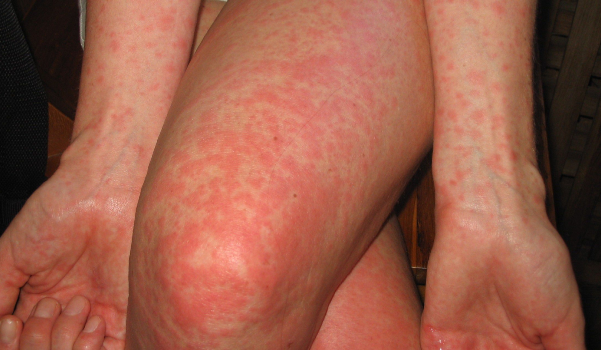 Tifüs Hastalığı Nedir?