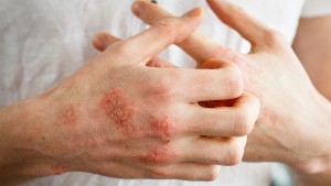 Ellerde Hassasiyet Egzama Habercisi Midir