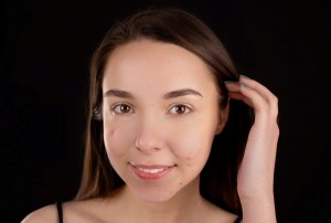 Sivilce Özgüveni Sarsıyor