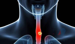 Akalazya Hastalığı Nedir?