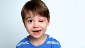 Anjioödem Hastalığı Nedir?