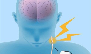 Obezite Vagal Sinirleri Tahrip Ediyor!