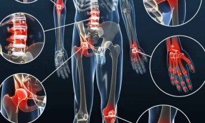 Romatizmal Hastalıklar