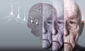 Alzheimer Hastalığı