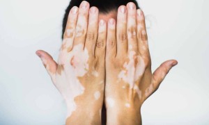 Ciltte Pigment Değişimleri