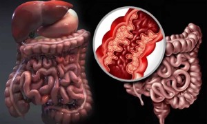 Crohn Hastalığı