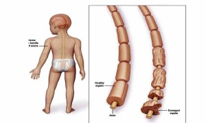 Guillain-Barre Sendromu