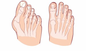 Halluks Valgus