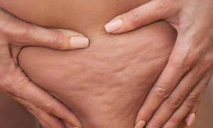 Selülitiniz Hangi Tip?