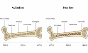 Osteogenesis İmperfekta