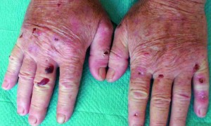 Porfiria (Porphyria)