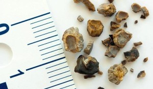 Böbrek Taşı Belirtileri