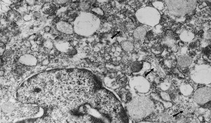 Erdheim Chester Hastalığı