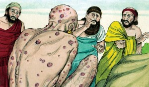 Cüzzam Hastalığı