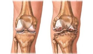 Diz Eklemi Artrozu