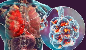 Lejyoner Hastalığı Nedir?