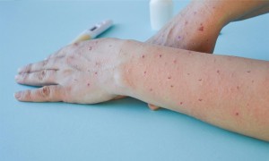 Maymun Çiçeği Virüsü (Monkeypox)
