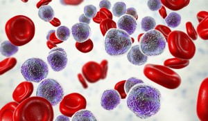 MDS Hastalığı Nedir