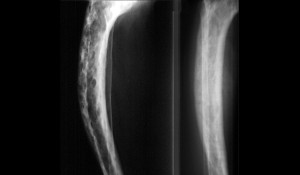 Paget Hastalığı Nedir?