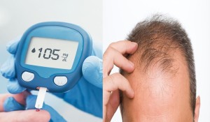 Şeker Hastalığı Saç Dökülmesi Yapar mı?