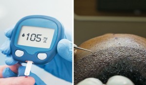 Şeker Hastaları Saç Ektirebilir mi?