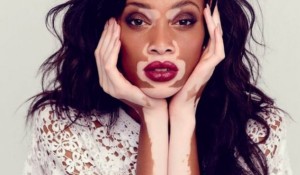 Ala Hastalığı Nedir?