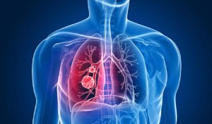 Zatürre (Pnömoni) Nedir?