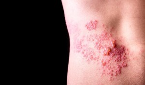 Zona Hastalığı Nedir?