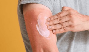 Güneş Yanığına Karşı Doğal Yöntemler