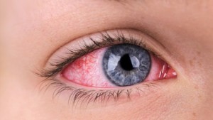 Kırmızı Göz Hastalığı Nedir?