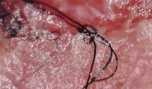 Morgellons Hastalığı Nedir?