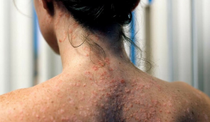 Sedef Hastalığı Nedir?