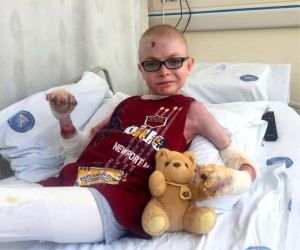 Kelebek Hastalığı Nedir?