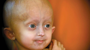Progeria Hastalığı Nedir?