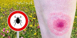 Lyme Hastalığı Nedir?